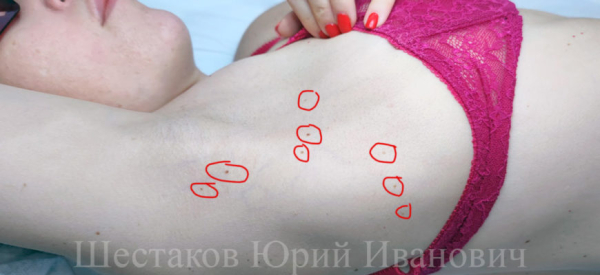 Бородавки на груди: причины и методы лечения