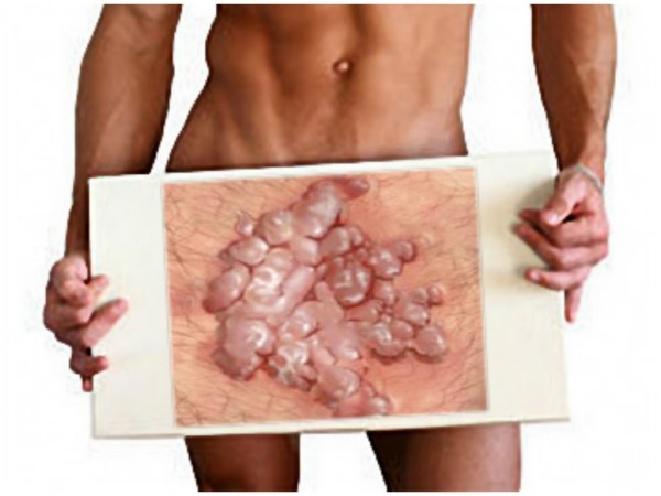 Папилломы на мошонке: причины, симптомы и лечение