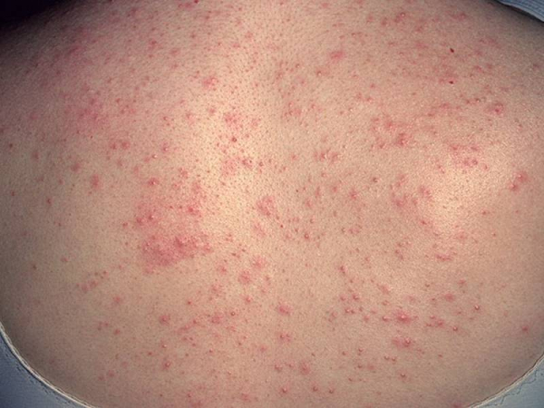 Кандидозный (грибковый) фолликулит: причины, симптомы и лечение