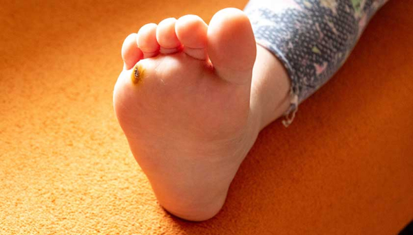 Как вылечить бородавку на стопе у ребенка