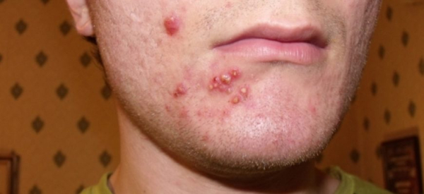 Кандидозный (грибковый) фолликулит: причины, симптомы и лечение