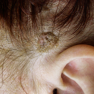 Бородавки на голове: причины, симптомы и лечение