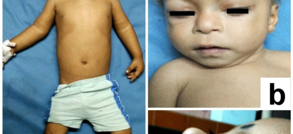 Синдром Костелло: причины, симптомы, диагностика и лечение