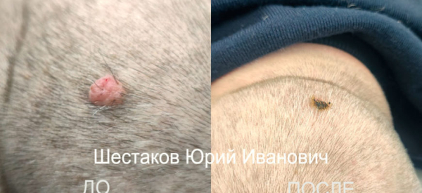 Бородавки на голове: причины, симптомы и лечение