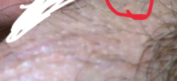 Папилломы на мошонке: причины, симптомы и лечение