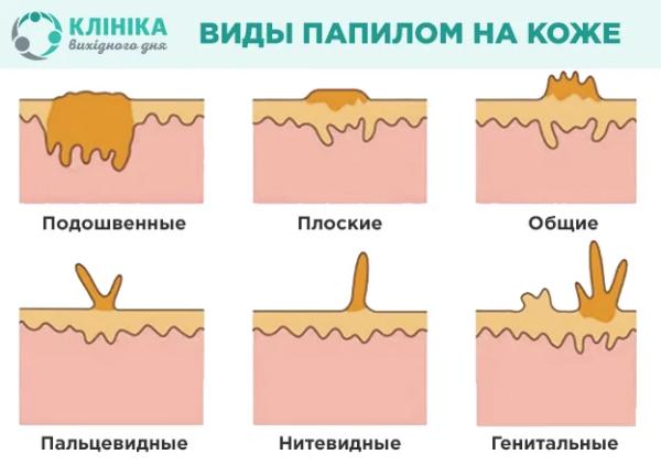 Висячие папилломы на шее: причины и лечение