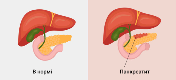 Паренхиматозный панкреатит: патогенез, лечение и профилактика